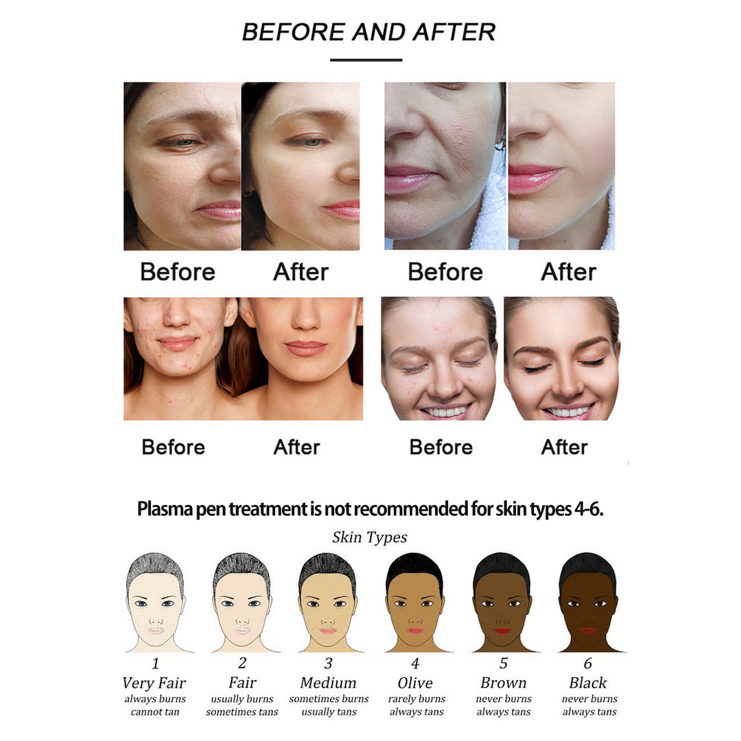 PLASMA PEN DEVICES FOR IMPROVING SKIN TONE-PLSA21