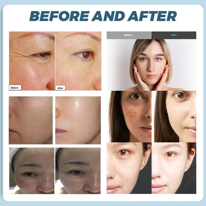 HYDRA JET PEEL NO NEEDLE MESOTHERAPY-H2.4