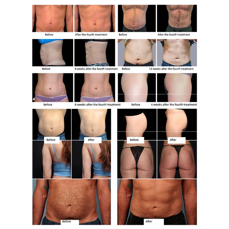 HES10R-EMSLIM NEO RF-Weight Loss/Body Sculpting-Slimming Machine